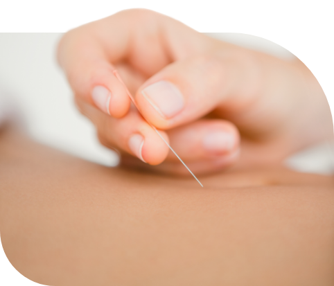 Photo: Trigger Point Dry Needling